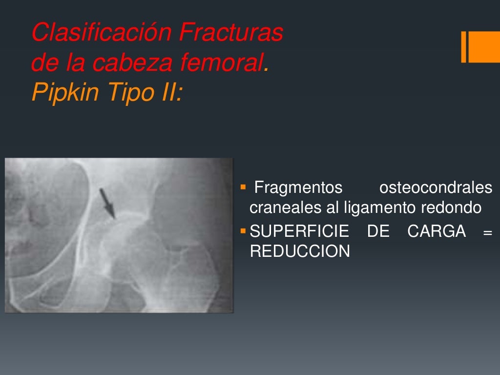 Fracturas De Femur Proximal