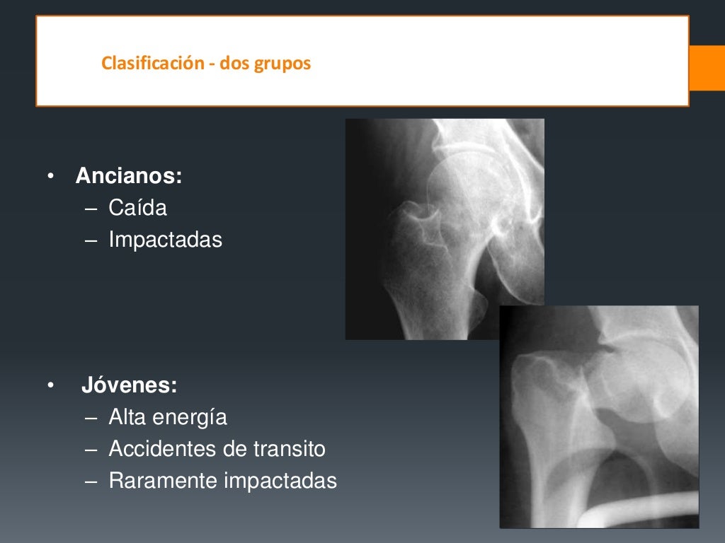 Fracturas De Femur Proximal