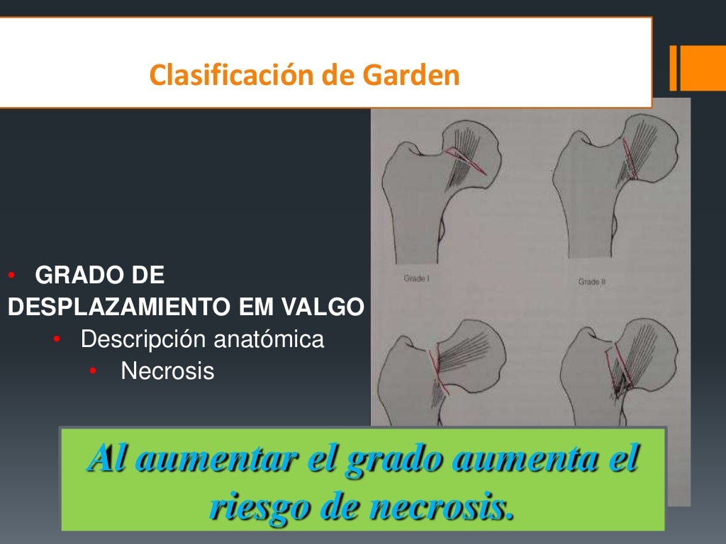 Fracturas De Femur Proximal