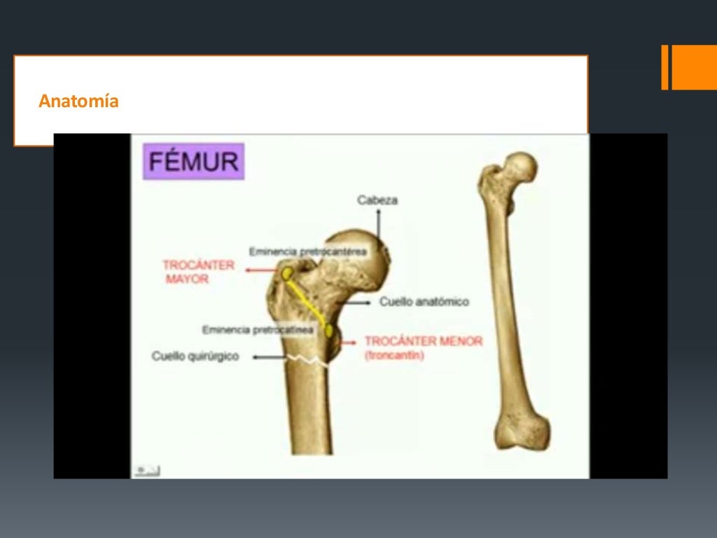 Fracturas De Femur Proximal