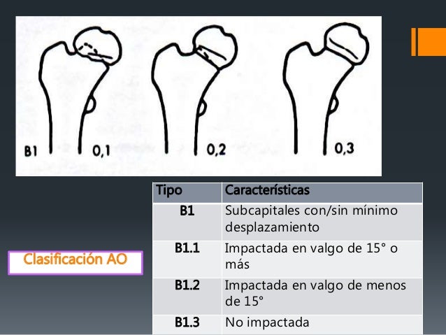 Fracturas De Femur Proximal