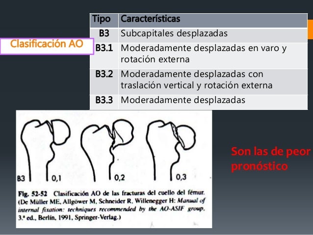 Fracturas De Femur Proximal
