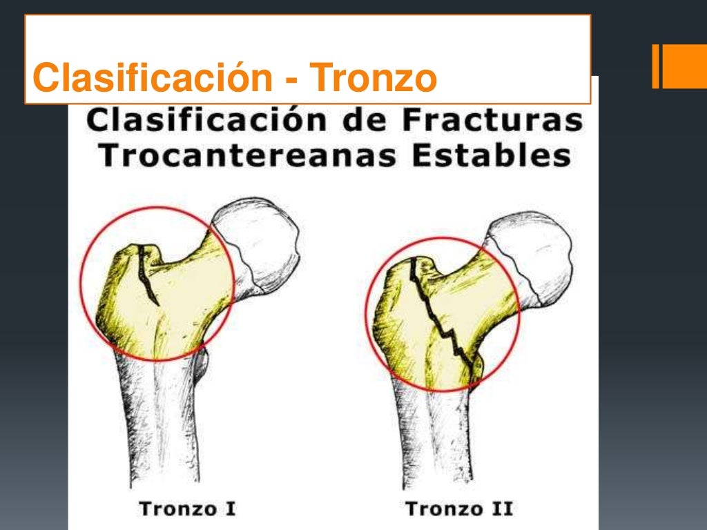 Fracturas De Femur Proximal