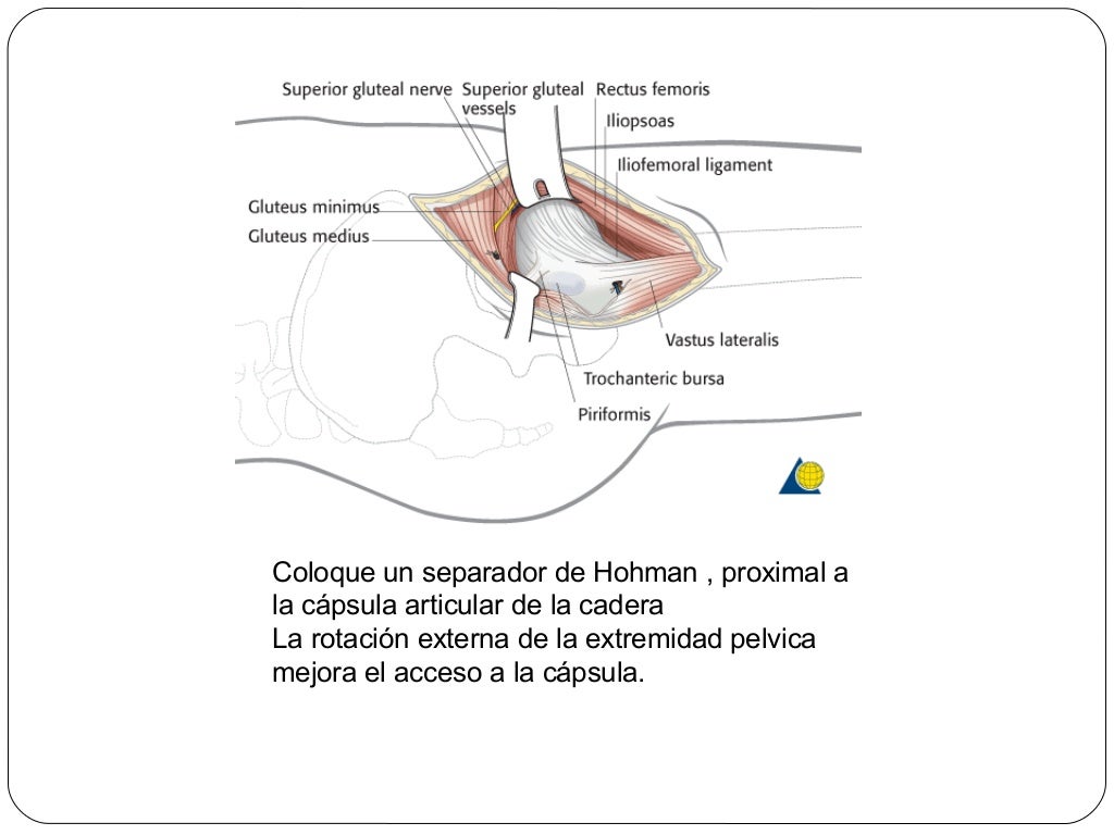 Fracturas De Femur Proximal 31 B