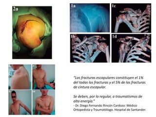 “Las fracturas escapulares constituyen el 1%
del todas las fracturas y el 5% de las fracturas
de cintura escapular.
Se deben, por lo regular, a traumatismos de
alta energía.”
- Dr. Diego Fernando Rincón Cardozo: Médico
Ortopedista y Traumatólogo. Hospital de Santander.
 