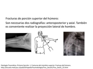 Fracturas de porción superior del húmero:
Son necesarias dos radiografías: anteroposterior y axial. También
es conveniente realizar la proyección lateral de hombro.
Patología Traumática. Primera Sección. 1. Fracturas del miembro superior. Fractuas del húmero.
http://escuela.med.puc.cl/publ/OrtopediaTraumatologia/Trau_Secc01/Trau_Sec01_22.html
 