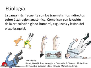Etiología.
La causa más frecuente son los traumatismos indirectos
sobre ésta región anatómica. Complican con luxación
de la articulación gleno-humeral, esguinces y lesión del
plexo braquial.
Tomado de:
Dandy, David J. Traumatología y Ortopedia. 2. Trauma. 12. Lesiones
del miembro superior. 186 p. Editorial Manual moderno.
 