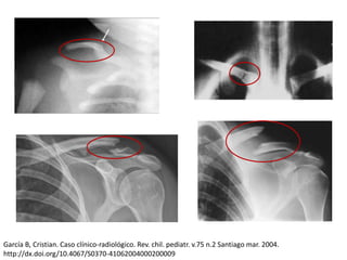 García B, Cristian. Caso clínico-radiológico. Rev. chil. pediatr. v.75 n.2 Santiago mar. 2004.
http://dx.doi.org/10.4067/S0370-41062004000200009
 
