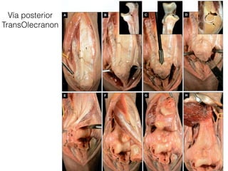 Vía posterior
TransOlecranon
 