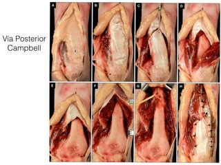 Vía Posterior
 Campbell
 