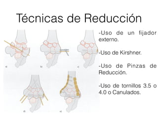 Técnicas de Reducción
             -Uso de un ﬁjador
             externo.

             -Uso de Kirshner.

             -Uso de Pinzas de
             Reducción.

             -Uso de tornillos 3.5 o
             4.0 o Canulados.
 