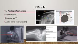 FRACTURAS DE HUMERO PROXIMAL DE LA ZONA EPISIARIA | PPTX