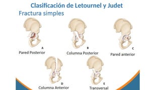 Judet Letournel Classification Fracturas del acetábulo, clasificacion y abordajes | PPTX