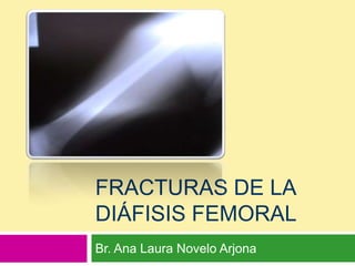 Fracturas de la diáfisis femoral Br. Ana Laura Novelo Arjona 
