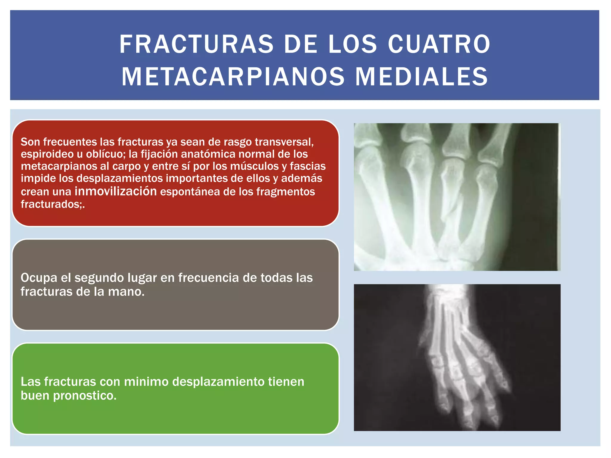 Fracturas de la mano | PPTX
