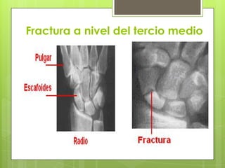 Fractura a nivel del tercio medio
 