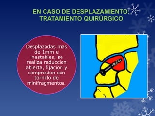 EN CASO DE DESPLAZAMIENTO:
     TRATAMIENTO QUIRÚRGICO



Desplazadas mas
    de 1mm e
  inestables, se
realiza reduccion
abierta, fijacion y
 compresion con
    tornillo de
minifragmentos.
 