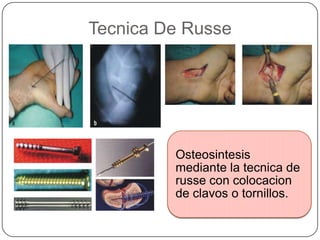 Tecnica De Russe




         Osteosintesis
         mediante la tecnica de
         russe con colocacion
         de clavos o tornillos.
 