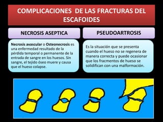 COMPLICACIONES DE LAS FRACTURAS DEL
               ESCAFOIDES
     NECROSIS ASEPTICA                       PSEUDOARTROSIS
Necrosis avascular o Osteonecrosis es
una enfermedad resultado de la          Es la situación que se presenta
pérdida temporal o permanente de la     cuando el hueso no se regenera de
entrada de sangre en los huesos. Sin    manera correcta y puede ocasionar
sangre, el tejido óseo muere y causa    que los fracmentos de hueso se
que el hueso colapse.                   solidifican con una malformación.
 