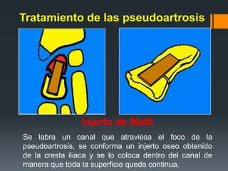 Tratamiento de las pseudoartrosis




                Injerto de Matti
Se labra un canal que atraviesa el foco de la
pseudoartrosis, se conforma un injerto oseo obtenido
de la cresta iliaca y se lo coloca dentro del canal de
manera que toda la superficie queda continua.
 