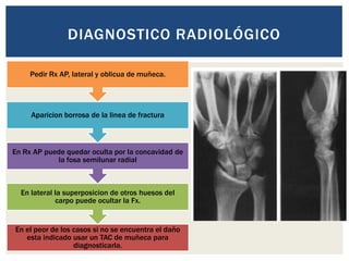 DIAGNOSTICO RADIOLÓGICO

     Pedir Rx AP, lateral y oblicua de muñeca.




     Aparicion borrosa de la linea de fractura



En Rx AP puede quedar oculta por la concavidad de
            la fosa semilunar radial



  En lateral la superposicion de otros huesos del
             carpo puede ocultar la Fx.


En el peor de los casos si no se encuentra el daño
   esta indicado usar un TAC de muñeca para
                  diagnosticarla.
 