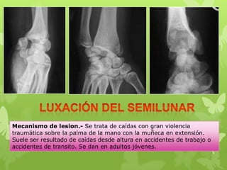 Mecanismo de lesion.- Se trata de caídas con gran violencia
traumática sobre la palma de la mano con la muñeca en extensión.
Suele ser resultado de caídas desde altura en accidentes de trabajo o
accidentes de transito. Se dan en adultos jóvenes.
 