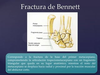 Fractura de Bennett




Corresponde a la fractura de la base del primer metacarpiano,
comprometiendo la articulación trapeciometacarpiano con un fragmento
triangular que queda en su lugar anatómico, mientras el resto del
metacarpiano se desplaza hacia radial y proximal por la tracción muscular
del abductor corto.
 