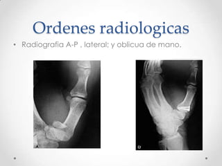 Ordenes radiologicas
• Radiografia A-P , lateral; y oblicua de mano.
 