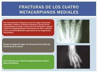 FRACTURAS DE LOS CUATRO
                   METACARPIANOS MEDIALES

Son frecuentes las fracturas ya sean de rasgo transversal,
espiroideo u oblícuo; la fijación anatómica normal de los
metacarpianos al carpo y entre sí por los músculos y fascias
impide los desplazamientos importantes de ellos y además
crean una inmovilización espontánea de los fragmentos
fracturados;.




Ocupa el segundo lugar en frecuencia de todas las
fracturas de la mano.




Las fracturas con minimo desplazamiento tienen
buen pronostico.
 