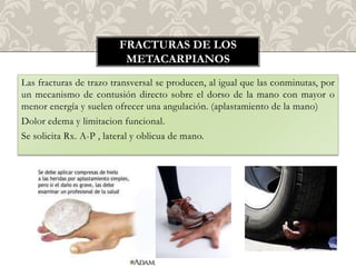FRACTURAS DE LOS
                          METACARPIANOS
Las fracturas de trazo transversal se producen, al igual que las conminutas, por
un mecanismo de contusión directo sobre el dorso de la mano con mayor o
menor energía y suelen ofrecer una angulación. (aplastamiento de la mano)
Dolor edema y limitacion funcional.
Se solicita Rx. A-P , lateral y oblicua de mano.
 