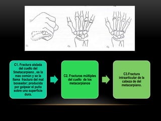 C1. Fractura aislada
     del cuello del
 5metacarpiano , es la
                                                       C3.Fractura
   mas común y se la     C2. Fracturas múltiples
                                                   intraarticular de la
llama fractura del mal      del cuello de los
                                                      cabeza de del
 boxeador; producida         metacarpianos
                                                     metacarpiano.
  por golpear el puño
 sobre una superficie
         dura.
 