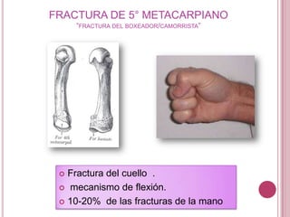 FRACTURA DE 5° METACARPIANO
     “FRACTURA DEL BOXEADOR/CAMORRISTA”




  Fractura del cuello .
  mecanismo de flexión.

  10-20% de las fracturas de la mano
 