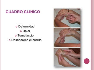 CUADRO CLINICO


      Deformidad
         Dolor

      Tumefaccion

  Desaparece el nudillo
 