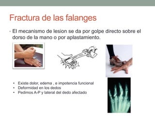 Fractura de las falanges
• El mecanismo de lesion se da por golpe directo sobre el
 dorso de la mano o por aplastamiento.




 • Existe dolor, edema , e impotencia funcional
 • Deformidad en los dedos
 • Pedimos A-P y lateral del dedo afectado
 