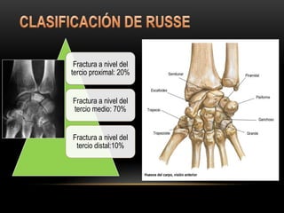 Fractura a nivel del
tercio proximal: 20%


Fractura a nivel del
tercio medio: 70%


Fractura a nivel del
 tercio distal:10%
 