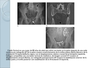 Cizalla Vertical en una mujer de 80 años de edad que sufrió una lesión en la pelvis después de una caída
mecánica.(a) radiografía AP de la pelvis muestra ensanchamiento de la sínfisis púbica (flecha blanca) y de la
articulación SI izquierda(flecha negra), con el desplazamiento relativo craneal de la hemipelvis izquierda,
hallazgos compatibles con una lesión vertical de cizalladura. (b) Imagen coronal CT muestra el
desplazamiento vertical (flecha). (c) radiografía postoperatoria AP muestra la estabilización anterior de la
sínfisis pubis y el anillo posterior con estabilización de la Articulación SI izquierda.
 