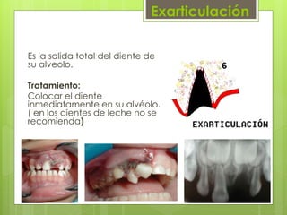 Exarticulación
Es la salida total del diente de
su alveolo.
Tratamiento:
Colocar el diente
inmediatamente en su alvéolo.
( en los dientes de leche no se
recomienda)
 