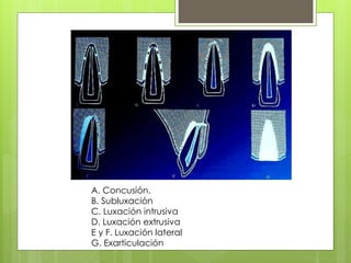 A. Concusión.
B. Subluxación
C. Luxación intrusiva
D. Luxación extrusiva
E y F. Luxación lateral
G. Exarticulación
 