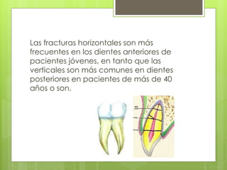 Las fracturas horizontales son más
frecuentes en los dientes anteriores de
pacientes jóvenes, en tanto que las
verticales son más comunes en dientes
posteriores en pacientes de más de 40
años o son.
 