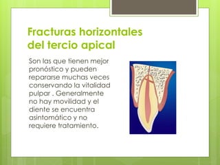 Fracturas horizontales
del tercio apical
Son las que tienen mejor
pronóstico y pueden
repararse muchas veces
conservando la vitalidad
pulpar . Generalmente
no hay movilidad y el
diente se encuentra
asintomático y no
requiere tratamiento.
 