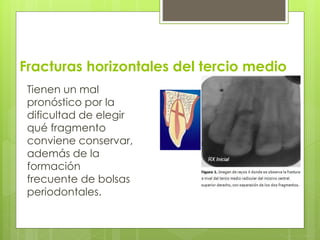 Fracturas horizontales del tercio medio
Tienen un mal
pronóstico por la
dificultad de elegir
qué fragmento
conviene conservar,
además de la
formación
frecuente de bolsas
periodontales.
 