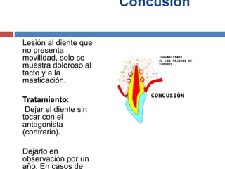 Concusión
Lesión al diente que
no presenta
movilidad, solo se
muestra doloroso al
tacto y a la
masticación.
Tratamiento:
Dejar al diente sin
tocar con el
antagonista
(contrario).
Dejarlo en
observación por un
año. En casos de
 