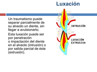 Luxación
Un traumatismo puede
separar parcialmente de
su alveolo un diente, sin
llegar a avulsionarlo;
Esta luxación puede ser
por penetración
o impactación del diente
en el alveolo (intrusión) o
por salida parcial de éste
(extrusión).
 