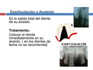 Exarticulación o Avulsión
Es la salida total del diente
de su alveolo.
Tratamiento:
Colocar el diente
inmediatamente en su
alvéolo. ( en los dientes de
leche no se recomienda)
 