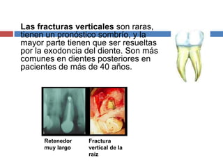 Las fracturas verticales son raras,
tienen un pronóstico sombrío, y la
mayor parte tienen que ser resueltas
por la exodoncia del diente. Son más
comunes en dientes posteriores en
pacientes de más de 40 años.
Fractura
vertical de la
raíz
Retenedor
muy largo
 