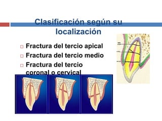 Clasificación según su
localización
 Fractura del tercio apical
 Fractura del tercio medio
 Fractura del tercio
coronal o cervical
 