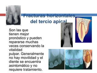 Fracturas horizontales
del tercio apical
Son las que
tienen mejor
pronóstico y pueden
repararse muchas
veces conservando la
vitalidad
pulpar. Generalmente
no hay movilidad y el
diente se encuentra
asintomático y no
requiere tratamiento.
 