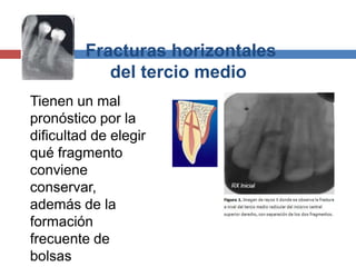 Fracturas horizontales
del tercio medio
Tienen un mal
pronóstico por la
dificultad de elegir
qué fragmento
conviene
conservar,
además de la
formación
frecuente de
bolsas
 