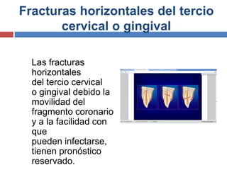 Fracturas horizontales del tercio
cervical o gingival
Las fracturas
horizontales
del tercio cervical
o gingival debido la
movilidad del
fragmento coronario
y a la facilidad con
que
pueden infectarse,
tienen pronóstico
reservado.
 