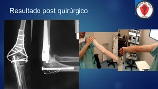 Resultado post quirúrgico
 